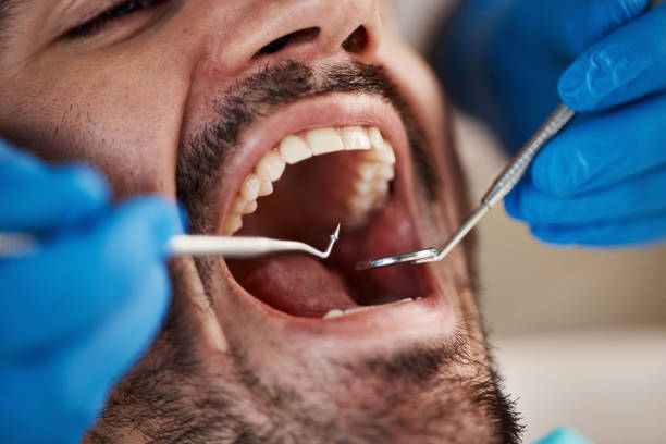 Best Emergency Wisdom Teeth Removal in Nekoosa, WI